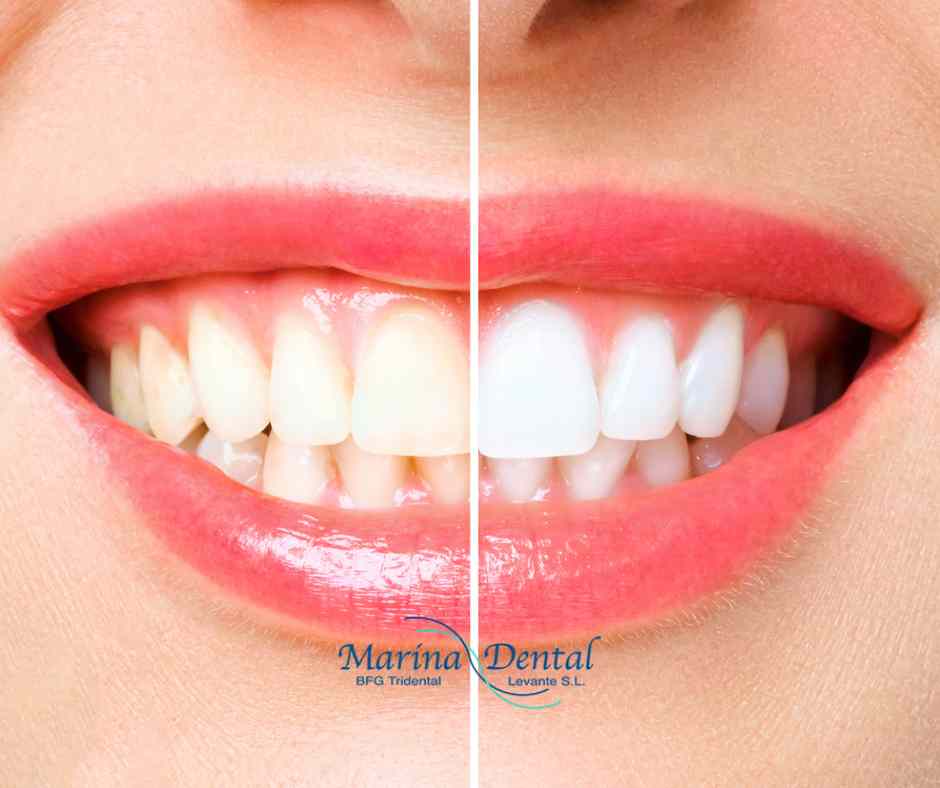 Los mejores consejos para un blanqueamiento dental seguro